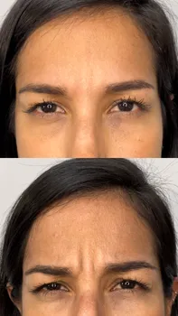 Toxina Botulínica