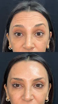 Toxina Botulínica