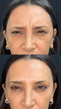 Toxina Botulínica