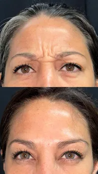 Toxina Botulínica