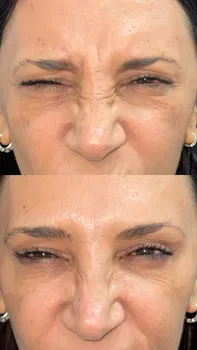 Toxina Botulínica