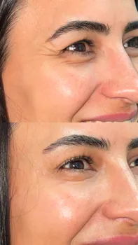 Toxina Botulínica