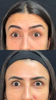 Toxina Botulínica