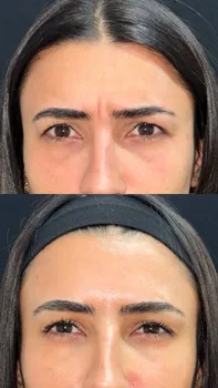 Toxina Botulínica